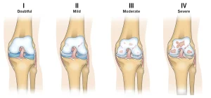 ماهو علاج خشونة الركبه؟: شكل خشونة الركبه بالصور 2