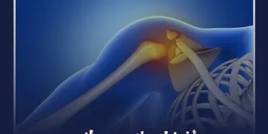 أفضل واسرع علاج لهشاشة العظام