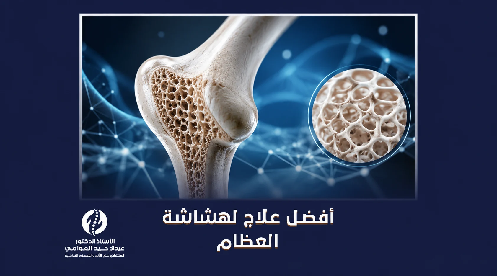 أفضل علاج لهشاشة العظام